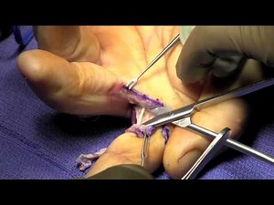 Index Finger Ray Amputation • Video • MEDtube.net