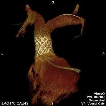 3DRA Post Melody Reconstructed