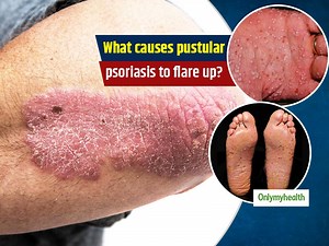 What Is Pustular Psoriasis? Types, Causes And Treatment
