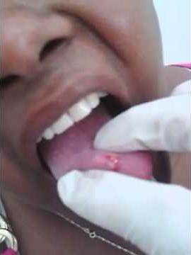 Tongue Cyst