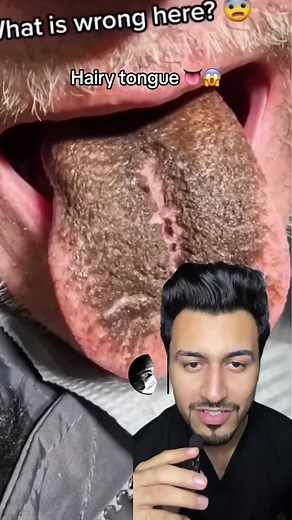 Understanding Hairy Tongue Condition