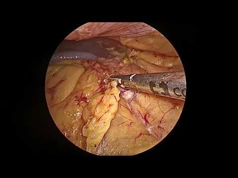 Laparoscopic left adrenalectomy - Dr Pinky Thapar