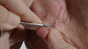 Acne treatment footage. Squeezing blackhead pimple with stainless steel medical acne remover tool. Pressing and removing blackhead pimple from earlobe skin. Acne skin problem closeup skincare concept.