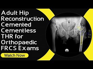 Adult Hip Reconstruction for Orthopaedic Exams  • Video • MEDtube.net