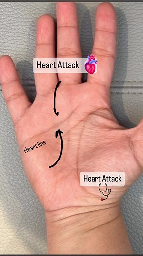 413K views · 689 reactions | Heart Attack sign in hand palmistry | Asad Raza -AR Palmistry Numerology | Facebook
