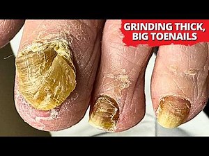 Cutting an Extremely Thick Toenail (SO Satisfying!)