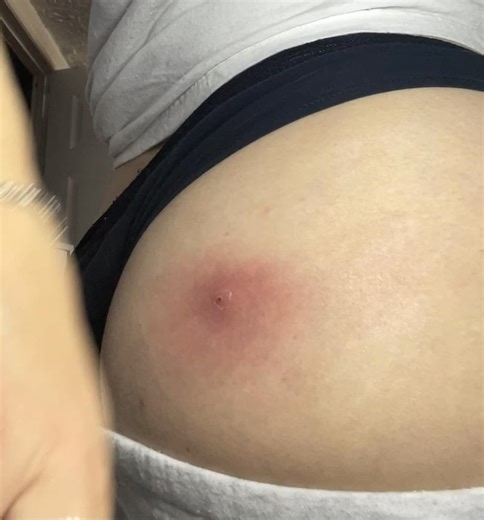 Staphylococcus aureus infection abscess draining; NSFW because on buttcheek