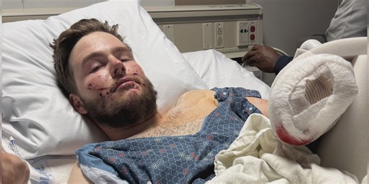 Recent high school grad at risk of losing his entire hand after a fireworks accident