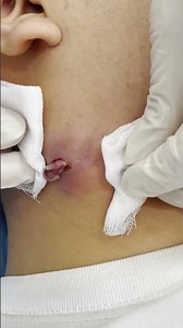 Nặn mụn áp xe nhiều dịch mủ.