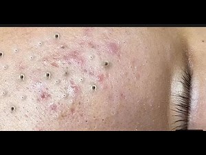 Satisfying And Relaxation with NaSa Beauty Spa #19 black point and acne extraction