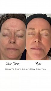 ✨ Glowing skin starts with consistency ✨ This beauty has been on a skin journey with one of our lead aesthetician, Sarah, for over 4 years. With the right homecare, regular medical-grade facials, and treatments like chemical peels, SkinPen, Limelight, & Ultra Laser, her glow just keeps getting better. Gorgeous results that come from trusting the process! 💫 #fayettevillearkansas #SkinPen #lasertreatments #glowjourney #expertskincare #radiantresults | Revive Medical Spa LLC