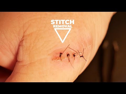 How to Remove Stitches from Home