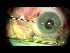 Cataract Surgery in a Small Pupil Flomax Patient Duke Eye Center