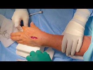 LEFT HAND EXTENSOR TENOSYNOVECTOMY