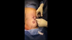 Lollipop Breast Lift Surgery Results (GRAPHIC)