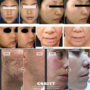 [Hot Item] Blacken Dpl Skin Care Device for Vascular Skin and Acne Marks and Redness Reduction