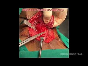 Total Thyroidectomy Procedure: A Surgical Step-by-Step Guide