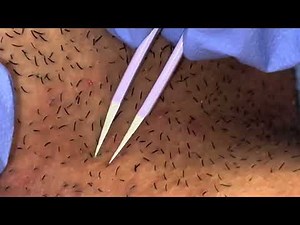 Plucking Ingrown Hairs from Neck