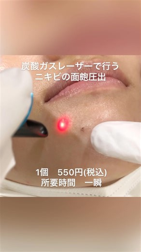 飯田橋ともじり皮ふ科【神楽坂|皮膚科・美容皮膚科】 on Instagram: "当院ではニキビ治療に力を入れています‼️﻿ 今回は炭酸ガスレーザーを使ってのニキビの面皰(めんぽう)圧出の治療風景です。﻿ ニキビでお悩みの方は是非当院にお越し下さい。﻿ 保険診療から自費診療まで幅広いご提案、治療が出来ます。﻿ ﻿ #飯田橋駅 #飯田橋 #神楽坂 #飯田橋皮膚科 #神楽坂皮膚科 #ニキビ #シミ #美容皮膚科 #皮膚科 #小児皮膚科 #飯田橋ともじり皮ふ科"