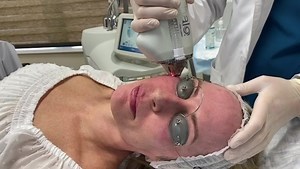 Benefits of Halo Laser Treatment ✨⁣ ⁣ • Each treatment is personalized to meet your specific needs⁣ ⁣ • Diminishes visible signs of aging⁣ ⁣ • Improves skin tone and texture for a youthful glow⁣ ⁣ • Minimizes enlarged pores⁣ ⁣ • Customizable treatments allow for flexibility in scheduling and downtime⁣ ⁣ Get back to GLOWING skin ✨ Call our office to schedule your appointment at 561-571-4000. | Lickstein Plastic Surgery