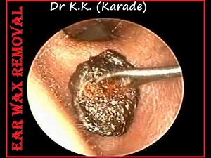 Easy Technique to remove Hard Impacted Ear Wax