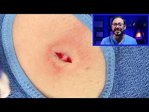The blossoming chest cyst and the history of the scalpel
