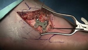 Calcaneal-Cuboid Fusion Utilizing a Low-Profile Variable Angle Locking Compression Plate