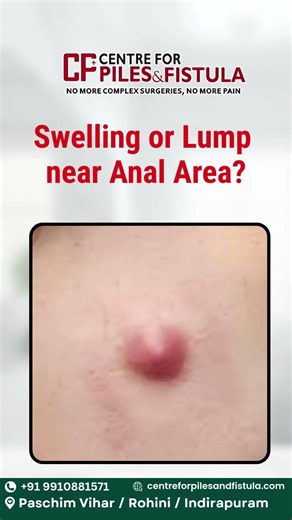 Pain during bowel movements, swelling near the anal area while sitting should never be ignored
