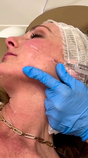 SCULPTRA ✨ Sculptra is a bio-stimulator, not a facial filler, meaning it helps our body stimulate its own collagen. Collagen is what gives our skin volume and prevents it from wrinkling and hollowing as we age. When injected into areas of the face such as the temples, cheeks, lower face, and jawline, Sculptra activates the skin’s regenerative process by replenishing lost collagen. Sculptra does not gives instant results, but rather develops over a series of treatments and time, giving you a natu