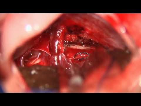 MS: Left retrosigmoid for resection of lipomatous petrotentorial meningioma