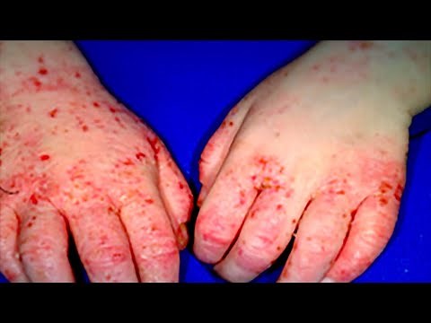 How to Diagnose Your Child’s Rash and When to Worry