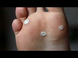 How to apply Wart Gel using a Micro Pen