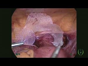 Laparoscopic Hysteropexy For Prolapse Uterus