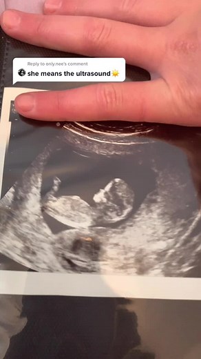 Reply to @only.nee here is the ultra sounds! 💕😽 #foryoupage #foryou #foryoupage #fyp