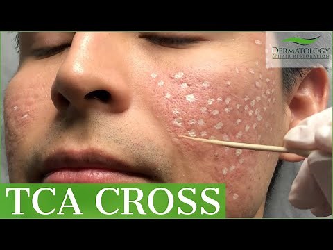 Acne Scar Removal with TCA Cross 80% - Los Angeles - Dr. Ben Behnam