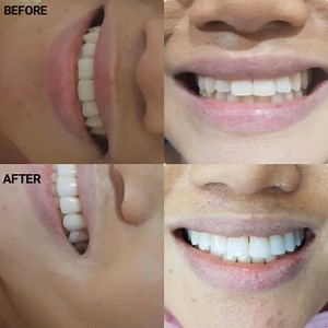 Achieving longer and whiter teeth through direct composite veneers- as requested by the patient. Now #APOSTOLified ⭐ .. .. .. .. .. #apostoldentalcosmeticcenter #dentistry #cosmeticdentistry #makatidentist #wheninmakati #wheninmanila #dentistinmakati #dentistph #dentaltourism #dentistphilippines #dentalphilippines #loveyoursmile #confidentlybeautiful #dentistwithaheart #allaboutteeth #directveneers #veneersph #makativeneers #smilemakeover #smiletransformation #smiledesign #smileenhancement #smil