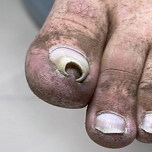 Installing a titanium thread to help with twisted toenails! | This Is Brainy