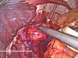 Laparoscopic Nissen Fundoplication • Video • MEDtube.net