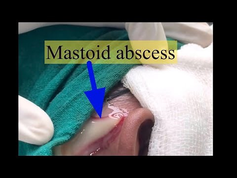 Mastoid abscess drainage||mastoid abscess 😳