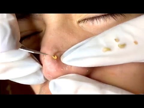 Pimple Popping 2020 Video #06| Blackheads, Whiteheads & Inflamed removal acne treatment
