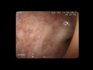 colonoscopy of severe ulcerative colitis