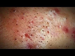 Most Satisfying Blackhead Removal Compilation! WARNING!