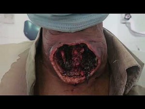 Maggots infestation of neck wound.
