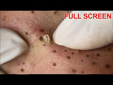 Blackheads Removal - Best Pimple Popping Videos