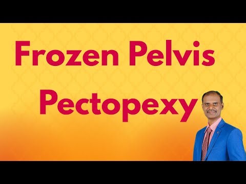 Laparoscopic Pectopexy for Vault Prolapse
