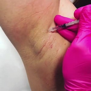  Do you suffer from excessive sweating, known as...