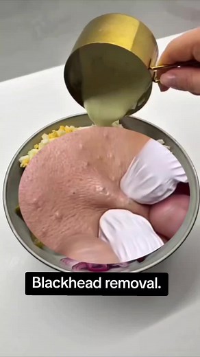 Blackhead removal.#pimple #pimplepoppen #satisfyingvideos #blackhead #f