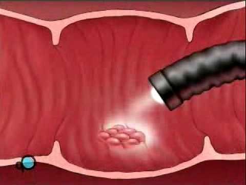 Endoscopy of Large Intestine
