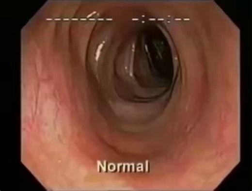 Doctors are seeing this inside people’s colons… and it’s NOT pretty 😱We are seeing colonoscopies that compare healthy vs diseased colons and the difference is shocking.➡️ Healthy colon: Smooth, pink, clean walls — like a fresh garden hose. ➡️ Diseased colon: Inflamed, covered in parasites (yes, live moving worms), candidiasis (yeast overgrowth), polyps (precancerous growths), and years of chronic constipation buildup.These aren’t rare cases anymore. Poor diet, stress, antibiotics, and processed
