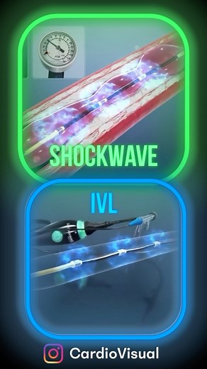 Coronary Calcified Plaque & Shockwave IVL Balloon Treatment Coronary calcified plaque 🩺, a manifestation of coronary artery disease (CAD), involves the accumulation of calcium deposits in coronary arteries. This buildup narrows the arteries, reducing blood flow to the heart. Shockwave Intravascular Lithotripsy (IVL) 💥🎈 is a medical procedure that employs sonic pressure waves to disrupt calcified plaque within the arteries. This process aims to restore proper blood flow. Key Points: • IVL is a
